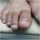 척척의원 | 남친이랑 다녀온 인천논현역 발톱무좀 진료 주손척척의원 발톱 케어 후기