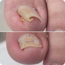 화인메트로병원 | 천안내성발톱수술 없이 레푸스 천안두정점에서 해결