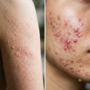 유*진 - 안양시 동안구 경수대로498번길 | 모공각화증·여드름 피부의 기적! 유사나 셀라비브 리무버로 매끈해진 사용후기(사진 유)