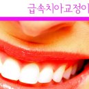 급속 치아교정하면 기간단축은 얼마나 될까요? 이미지