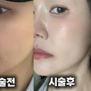 엔파로 | 엔진리프팅 얼굴 속근육 피트니스 관리부터 효과 가격 후기