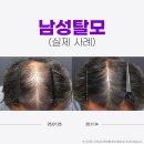 계성초등학교 | 정수리 탈모 80% 진행 상태, 반포동탈모병원 현실적인 치료 방향