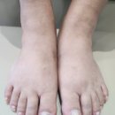 슬찬한방병원 | 운양동 내성발톱 무좀 치료 호전된 후기