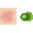 거대세포 바이러스 질환 (Cytomegaloviral diseases) 이미지
