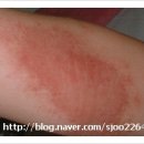 청담BS한의원 | 아토피치료후기 사진포함 (안산피부과/안산아토피치료/안산한의원)