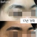 더블류성형외과 네이버블로그