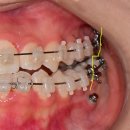 RPE10 | 악궁확장장치(RPE, MARPE) 용도, 역할, 장점, 단점, 기간, 후기 총정리