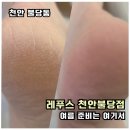 레푸스천안불당점 | 천안발각질제거 레푸스 천안불당점 뒤꿈치 굳은살 관리 후기