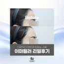 디파인피부과의원 | 이마부터 미간, 관자놀이까지 압구정 이유클리닉 필러로 자연스러운 상안부 윤곽 개선