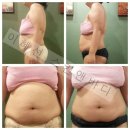 이혜선 미용실 | 비만관리 후기 /익산피부관리실 / 이혜선스킨앤바디