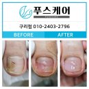경춘로458 | 멍든 발톱 복원 관리 후기 푸스케어 구리점 #발톱멍