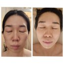 에스띠유 | ✨ 에스띠유 잠실피부관리 고주파 + 앰플 진정 관리 후기