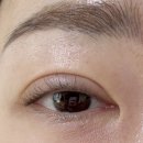 동태 조아 | 소세지눈 재수술 하구왔어요 1,2일차 대박성공 후기 + 쌍수 부분마취