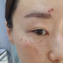 미라벨의원 | 기미 주근깨 레이저 /흉터 재생 미라벨의원에서 관리