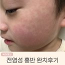 홍반 | 전염성 홍반 원인, 치료방법, 완치 후기