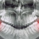 증상과 통증 없는데도 ‘사랑니’를 뽑아야 하는 이유는? 이미지