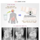 소장촬영small bowel series 이미지