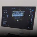 초이성형외과의원 | 직원 후기 / 히알라제 알레르기 걱정 없이 테르가제로 필러 녹이기