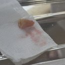 어금니 발치 후기 (사진혐주의)