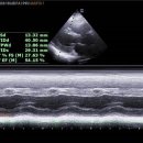pulmonary hypertension 이미지