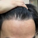 두드림성형외과의원 | 모발이식 1년 후기. 내돈내산내모 솔직후기