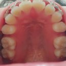 [교정일기] 20대 후반 성인 발치 교정, 아홉번째 진료 후기 (치아사진 O, 블록 제거)