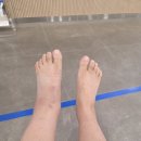 다병원 | 전거비인대, 종비인대 완전파열, 삼각인대 부분파열 다병원 수술 후기