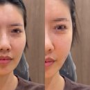같지만 다른 얼굴 | 소개팅 두 번 연속 실패하고 결국 얼굴 필러 했습니다. (강남피부과 얼굴필러 후기 내돈내산)