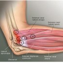 테니스 엘보(lateral epicondylitis) 이미지