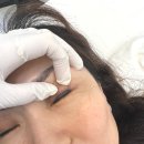 시흥 배곧 아이라인 문신제거 미작뷰티 시흥점