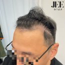 지스칼프