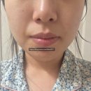 잠실새내역피부과 온다리프팅 후기