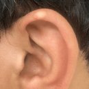 “귓바퀴에 생긴 하얀 결절”… 통풍 때문이라는데, 왜 이곳에? 이미지