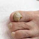 영등포발톱무좀 40년 묵은 고민 깔끔하게! 포쉬네일 오벨리네일푸스 족보있는그녀들 금천점