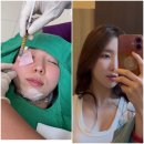 11탄-여드름 흉터 치료 후기 :프락셀보다 중요한 건 탄력? 실리프팅·지방이식 리얼 후기