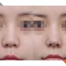무보형물 코성형으로 원하는 코라인 만들기 (히트성형외과 코끝성형)