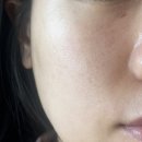 신&손비뇨기과의원 | 신촌피부과 유온느의원에서 찾은 맑은 피부 : 주근깨 제거 2회차 후기