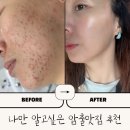 민채뷰티 | 대구 압출, 여드름관리 추천 (내돈내산 후기)