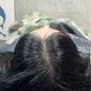 탈모의해답 | 탈모 고민의 두피문신 후기 새로운 해답(정수리 문신, 헤어라인 문신, 두피타투)