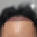 용닥터의원 | [모발이식] 용닥터의원 | 절개 모발이식 후기 내돈내산