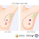 유방암의 치료방법 이미지