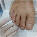 척척병원 | 남자친구 발톱무좀 치료기 ~ 주손척척의원