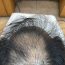 심한 남자 탈모 고민 끝, 정수리 전체 시술로 되찾은 자신감! (가족 대리 예약방문)/ 김해남해거제창원마산진해용원녹산화명명지하단엄궁장 이미지