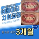 보우치과의원 | 하안동 교정 연세365치과, 아이 이가 거꾸로 물려요 - 소아 1차 교정 후기(feat.인버티드 라비알 보우)