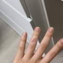심재성화상치료 화상진단비포함 화상실비 환급 받는 법 손가락 화상 흉터 관리법