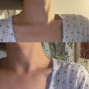 강남 가로 목주름필러 잘하는곳 플레저에서 7일차 만족스러운 후기