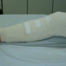 Re:cylinder splint 가 뭔가요? ^^; 이미지