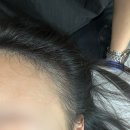 양천구생장술관리 아름뷰티 헤어라인생장술