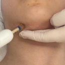 멍뷰티 | [원주 피부관리] 안녕예쁜아&amp;올타임뷰티 에어부스터 히알펜 관리 후기