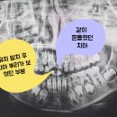 집에서 유치 발치 후 치아 뿌리가 보여 치과 진료받은 후기 (서울 필치과)